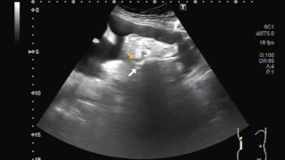 Ultrasound Video showing Renal stones.