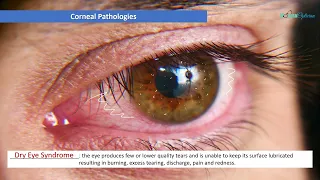 Optician Training: Corneal Pathologies (Ocular Anatomy Lecture 22)