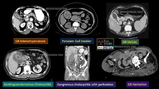 GALL BLADDER PATHOLOGIES