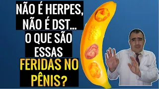 FERIDAS NO PÊNIS: que pensar quando não são causadas por doenças sexualmente transmissíveis (DSTs)?