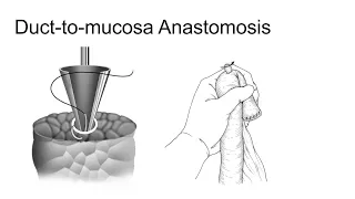 Duct-to-mucosa pancreaticojejunostomy for a non-dilated pancreatic duct