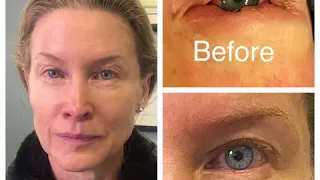 Left Lower Eyelid Skin Cancer Reconstruction Surgery testiomonial