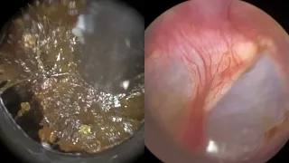 173 - Ear Wax Removal In Bruised Ear Stained with Blood due to Cotton Swab Misuse with the WAXscope