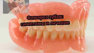 Флюороз зубов: симптомы и лечение