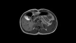 Pâncreas: Anatomia por TC, RM e USG.