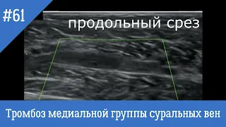 УЗИ сосудов (Видиофрагменты 61, 62). Тромбоз медиальной группы суральных вен.