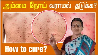 🔴Video: Chickenpox Signs and symptoms  in Tamil | Prevention & Treatment  for chickenpox