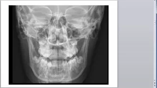 Basic Radiology of the Skull