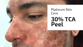 Platinum Skin Care 30% TCA demo (vegan)