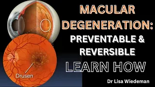 Easy to Understand Explanation PROTECT YOURSELF FROM LOSING VISION from Macular Degeneration