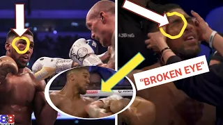 BREAKING NEWS: ANTHONY JOSHUA SUFFERS BROKEN EYE SOCKET IN LOSS TO OLEKSANDR USYK !