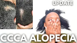 CCCA Alopecia Hair & Scalp Care | Update #alopecia