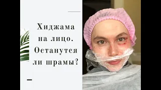 Хиджама на лицо - подтяжка кожи, уменьшение морщин, уменьшение пигментации и пор