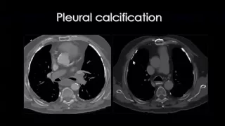 Imaging of Pleural pathology   DRE 9   Dr Mamdouh Mahfouz