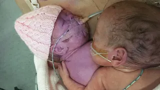 After Placing A Dying Baby Next To His twin, The Unbelievable Happened!!