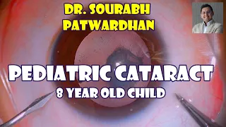 130 Pediatric cataract- 8 year old child- thought process Dr Sourabh Patwardhan