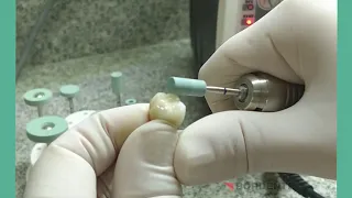 Pedras Bordente Diamant degaste em Zircônia, Cerâmina (Odontologia, Prótese, Implantes)