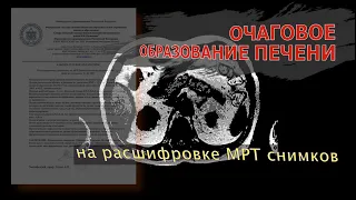 Очаговое ОБРАЗОВАНИЕ ПЕЧЕНИ и хронический панкреатит на РАСШИФРОВКЕ МРТ брюшной полости