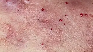 SAC DEP SPA Blackheads | #644