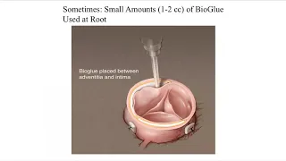 Surgery for Aortic Dissection -  New Therapies for an Old Disease