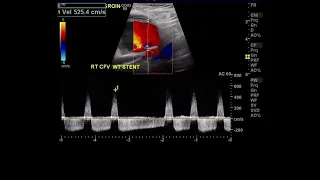 CFA Pseudoaneurysm