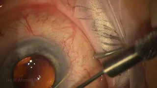 Surgery: Xen Glaucoma Surgery: Ideal Subconjunctival Placement