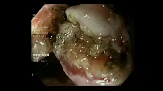 ZENKER' DIVERTICULAR SEPTOTOMY