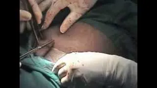 Caesarean Section: Step 6 - Closure of Abdomen