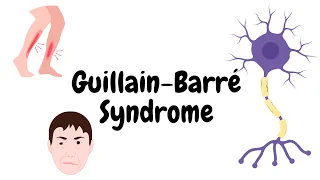 Understanding Guillain-Barre Syndrome