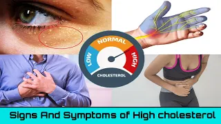 8 common signs and symptoms of High Cholesterol You Should Not Ignore