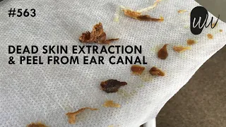 563 - Dead Skin Extraction & Peel from Ear Canal