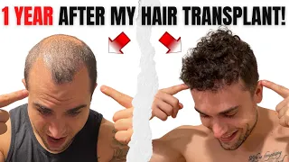 1 Year FUE Hair Transplant Results from Istanbul Turkey | Before and After!