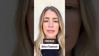 Botox Results 14 Days After Treatment