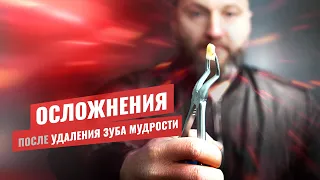 🇺🇦 Удалили зуб мудрости, какие могут быть осложнения