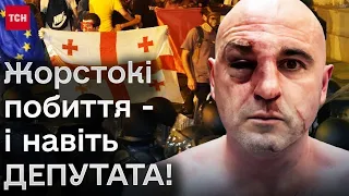 😲 Депутат зі ЗЛАМАНИМ НОСОМ і ПІДБИТИМ ОКОМ! У Грузії жорстоко розганяли протест