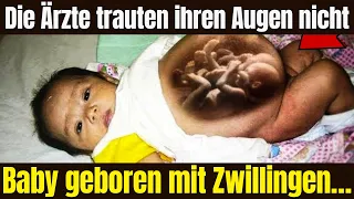 Die Ärzte trauten ihren Augen nicht, Baby geboren mit Zwillingen…