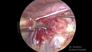 Bladder Dissection in TLH