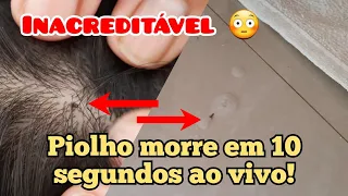 EXTERMINA O PIOLHO EM 10 SEGUNDOS 😳 | get rid of lice in 10 seconds