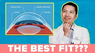 A MUST WATCH: How to Get the Best Scleral Lens Fit!!!!!