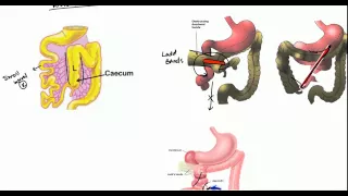 Gut Malrotation, Nonrotation and Volvulus for USMLE