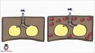 Pneumothorax and Tension Pneumothorax