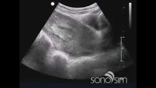 SonoSim Ultrasound Challenge: SonoSim Ultrasound Challenge - #ObGyn