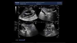 Ultrasound Video showing a stone in ureter of both kidneys.