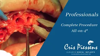 All-on-4® Complete Procedure by Dr. Cris Piessens | Algarve Dental Implants (ENG)