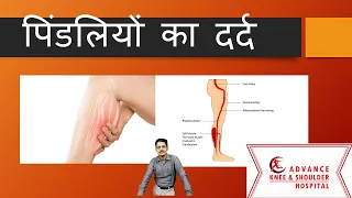 Calf Pain(Hindi) पिंडलियों का दर्द