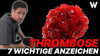 Lebensgefahr Thrombose: 7 Warnzeichen und wichtige Tipps gegen Thrombosen