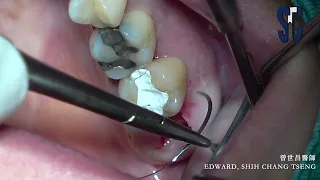 Functional crown lengthening