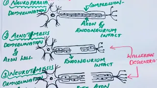 CLASSIFICATION OF PERIPHERAL NERVE INJURIES