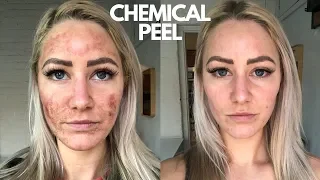 Chemical Peel On Sensitive Skin (NEVER AGAIN!!!)