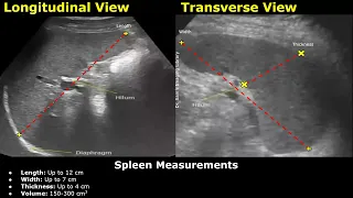 How To Measure The Spleen On Ultrasound | Splenic Length, Width, Thickness & Volume Measurements USG